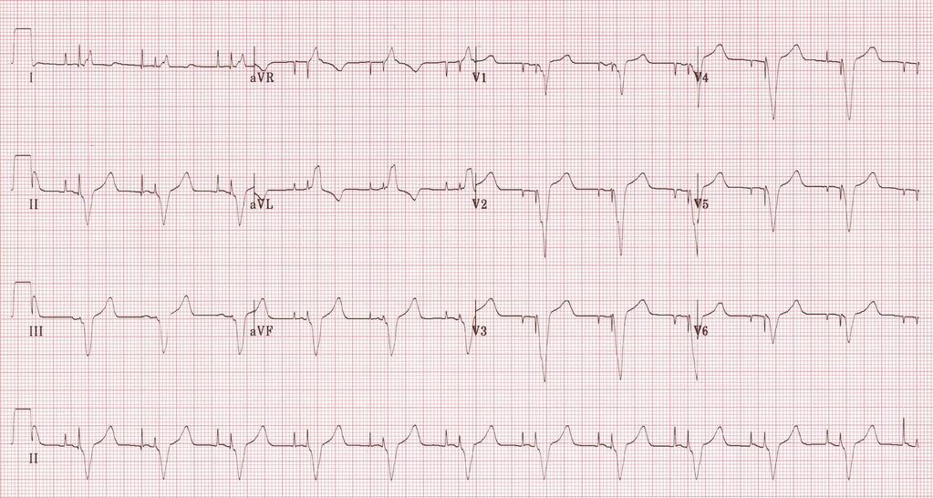 sequential pacing pacemaker.