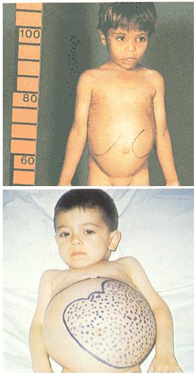 JUVENILE MYELOMONOCYTIC LEUKEMIA OVERVIEW Hematopoie'c disorder of infancy caused by excessive prolifera'on of monocy'c and granulocy'c cells; which infiltrate the spleen/liver, intes'nes and lungs