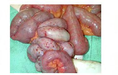 Small Bowel Neuroendocrine Tumors High risk of complications