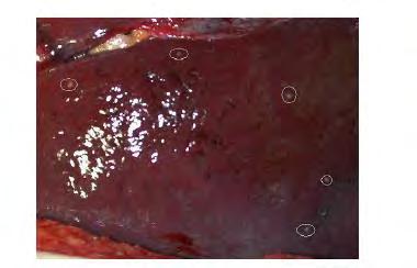 Neuroendocrine Liver Metastasis (NLM) Liver is the most common site of metastatic disease The majority of