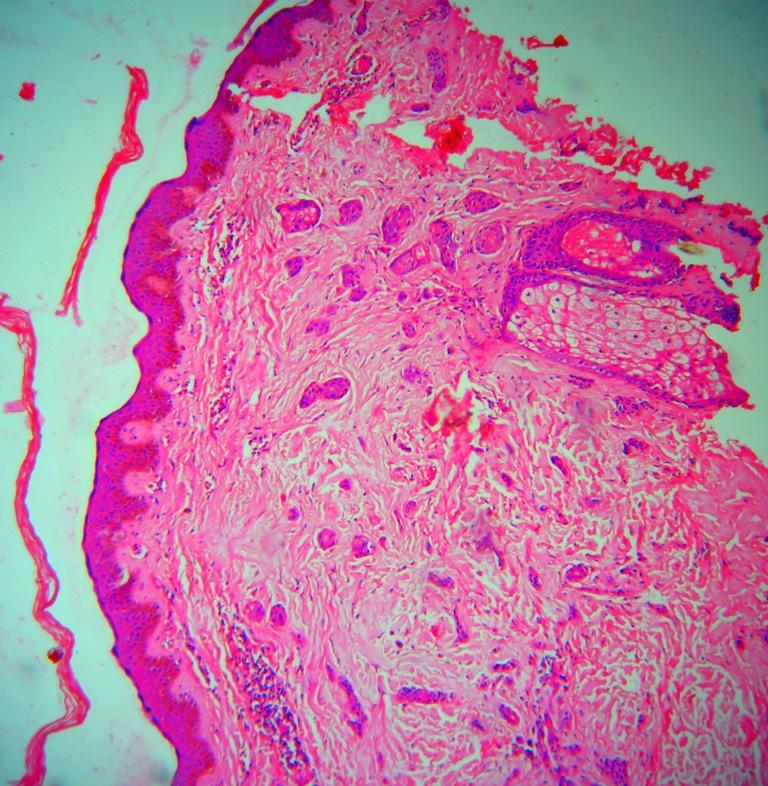 showing verrucous carcinoma (H&E,40X)