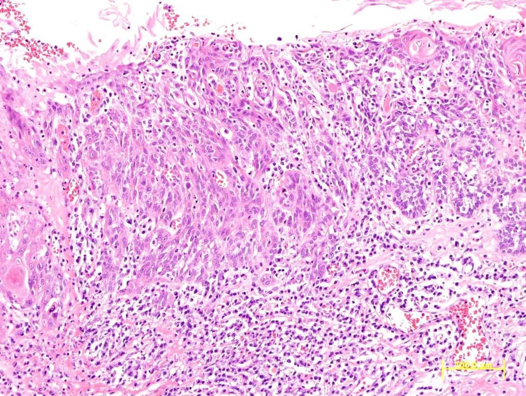 Risk factors for lymph node metastasis in superficial HNSCC 21 carried out every 6 months to detect any lymph node metastasis.