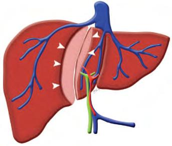 Radiology Rounds A Newsletter for Referring Physicians Massachusetts General Hospital Department of Radiology Imaging for Pre-Transplant Evaluation of Living Donor Liver Transplantation Imaging plays