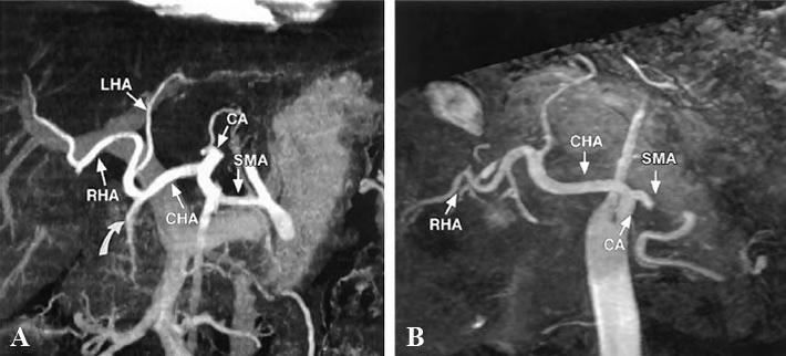 Figure 3. Reformatted images from CT (A) and MR imaging (B) data depict the normal course and branching pattern of the hepatic artery.