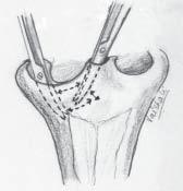 Figure 10a: Closed alar dissection on the left side Figure 10b: Closed alar dissection on the non-cleft side Figure 11: Septal cartilage dissected off the mucoperichondrium on both sides and from