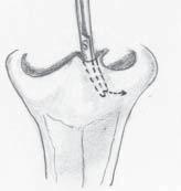 The medial approach is from the incision at the base of the columella. Laterally, the scissors are introduced at the base of the ala through the peri-alar incision.