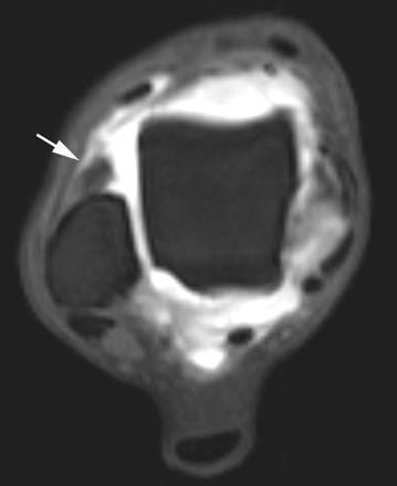 Imaging features MRI Adds to diagnosis?