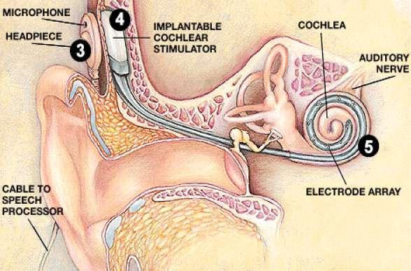 Cochlear
