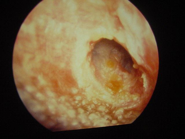 Otitis Externa Start ear drops early NOT oral Antibiotic Sofradex / Ciloxan