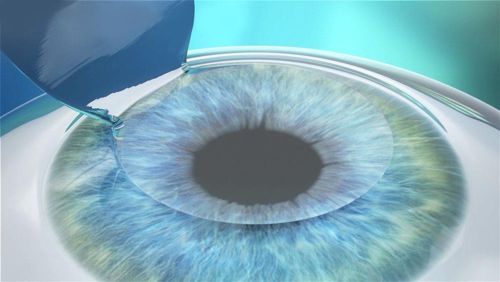 LASIK Post-op Pain Medication After LASIK, some amount of discomfort is common, though it s easy to manage