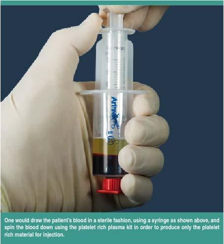 Osteoarthritis Treatment PRP Platelet Rich Plasma Still semi-investigational Clearly very safe Several supportive studies Best
