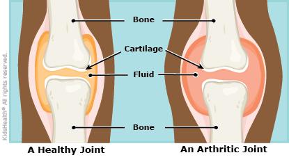 Arthritis Definition Arthritis - Painful