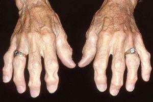 Types of Arthritis Non-inflammatory Osteoarthritis Most common Inflammatory