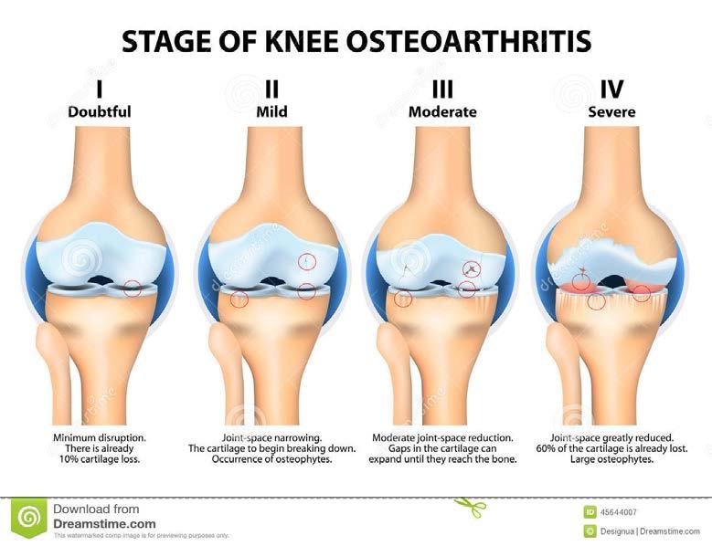 Osteoarthritis Primary No specific injury Obesity Secondary Related to the effects of