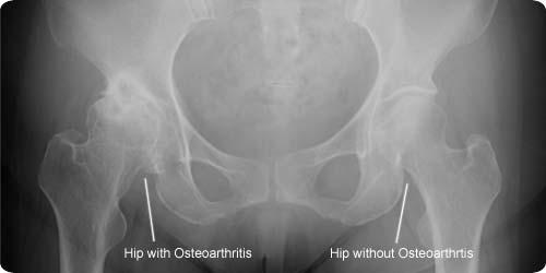 Osteoarthritis Combination of Symptoms - pain, swelling, stiffness of joints X-ray changes Joint space narrowing Osteophytes (Bone spurs) Bony