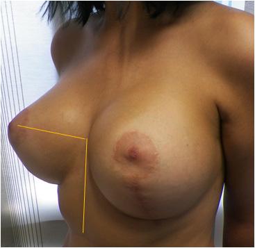 Here, we did not opt for a natural breast ptosis effect and directly restored the BK line to the BK point level; (C) and (D) note also that the BK angle is