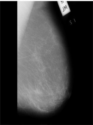 This method identifies accurately the stages of breast cancer. It can segment the cancer regions from the image accurately. It is useful to classify the cancer images for accurate detection.