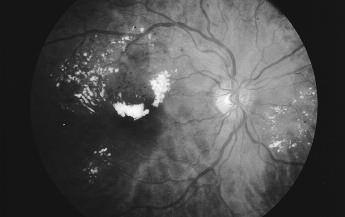 2. Causes and Associations The longer someone has diabetes mellitus, the more likely they will develop diabetic retinopathy.