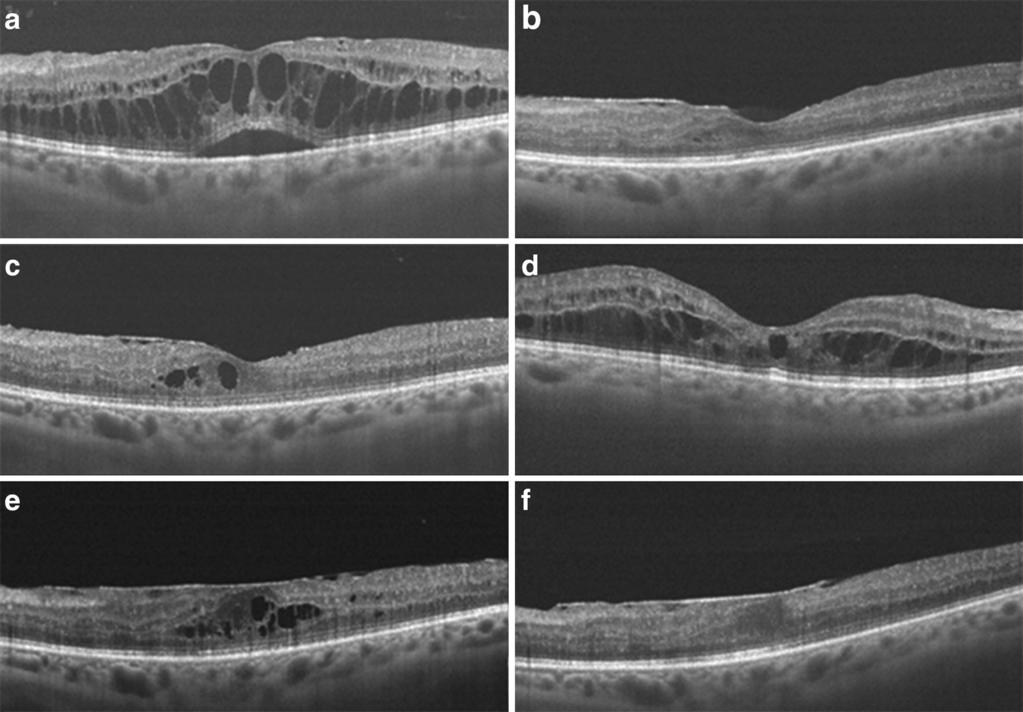 Ophthalmol Ther (2015) 4:51 58 53 Fig. 1 Changes in macular thickness in the left eye before and after fluocinolone acetonide (FAc) implant.