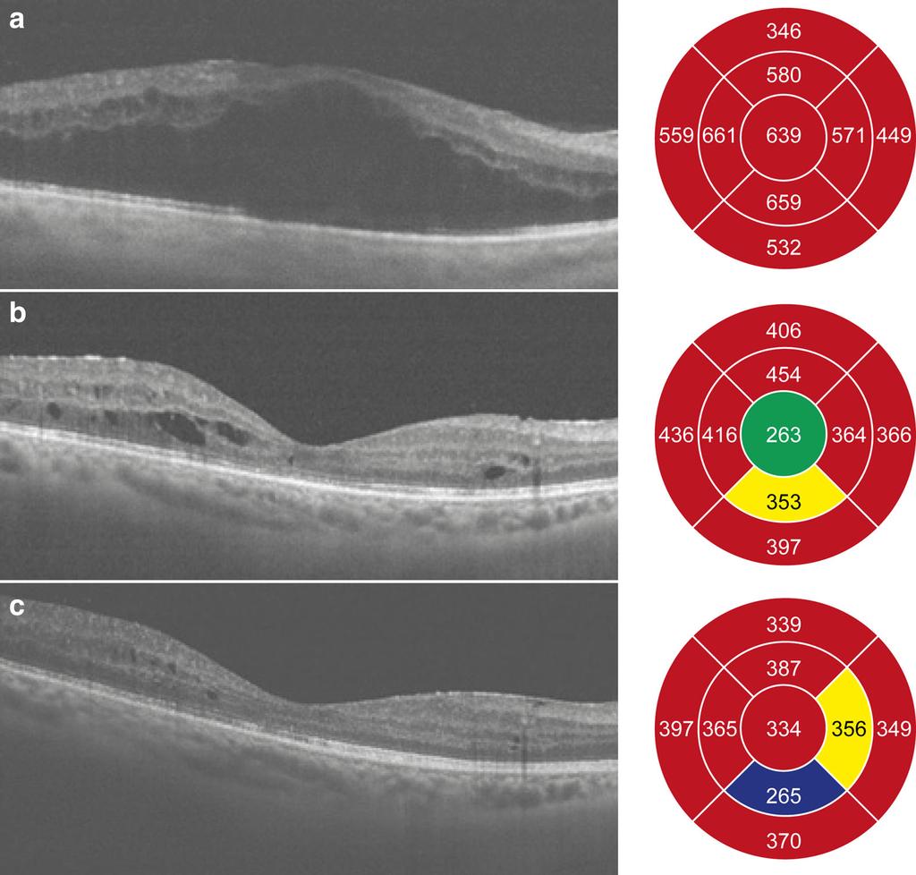 56 Ophthalmol Ther (2015) 4:51 58 Fig. 4 Changes in macular thickness (lm) in the right eye before and after fluocinolone acetonide (FAc) implant.