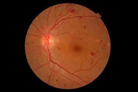5 PROLIFERATIVE DR Treatment with pan retinal laser reduces the risk of visual loss