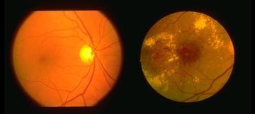 DIABETIC RETINOPATHY Defined as a clinical entity based on