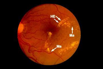 Intraretinal Hemorrhage Exudates Macular Edema Vascular Malformation