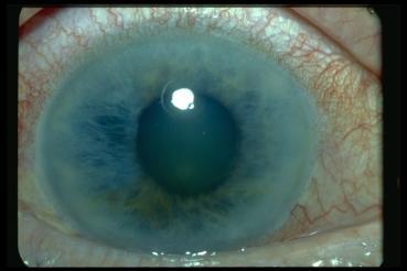SYMPTOMS Corneal haziness Eye redness 95 TREATMENT Check pressure