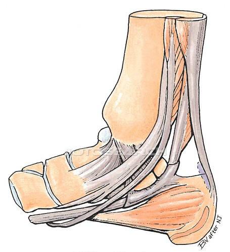 Achilles Tendon Repair: The Achilles tendon attaches the Gastrocnemius and the Soleus muscles to the calcaneus.