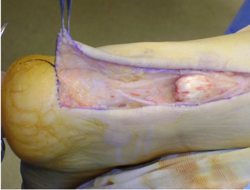 dissection through the subcutaneous layer to