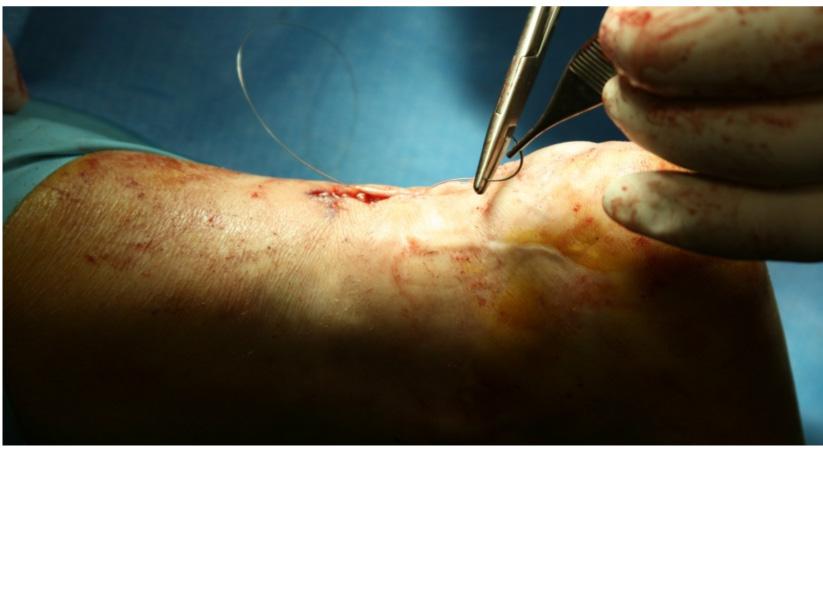 around the  Proximal and distal sutures are then placed to secure the