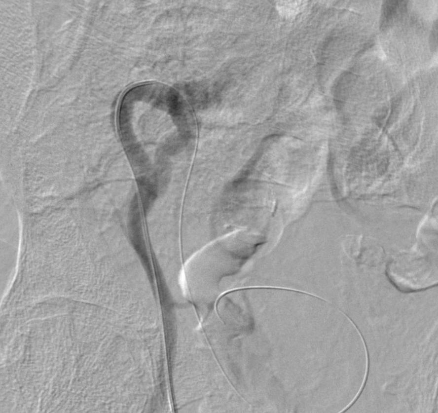 DIAGNOSTIC WORKUP- ANGIOGRAPHY * * Digital Subtraction Angiogram during presumed cannulation of the right internal iliac artery via C2 glide catheter from a right common femoral artery approach.