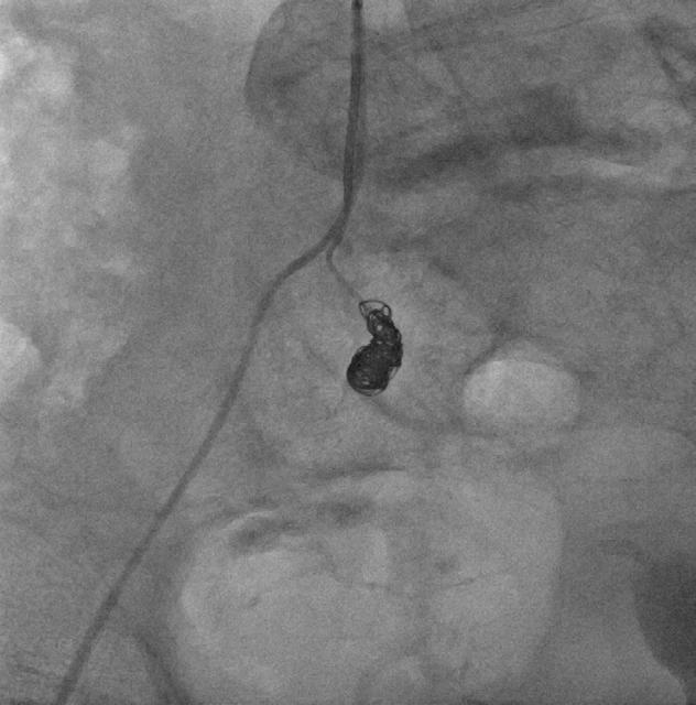 INTERVENTION Embolization and endovascular stent placement.