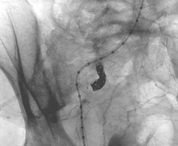 embolized using multiple Nester coils (arrow) via a right common femoral artery approach.