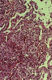 multinucleated giant cells