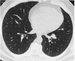 1987 L inferior pulmonary vein R inferior pulmonary vein Murray