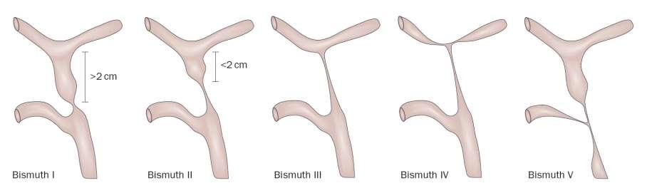 Bismuth Classification of Benign Biliary Stricture Zepeda-Gomez S, Baron TH.