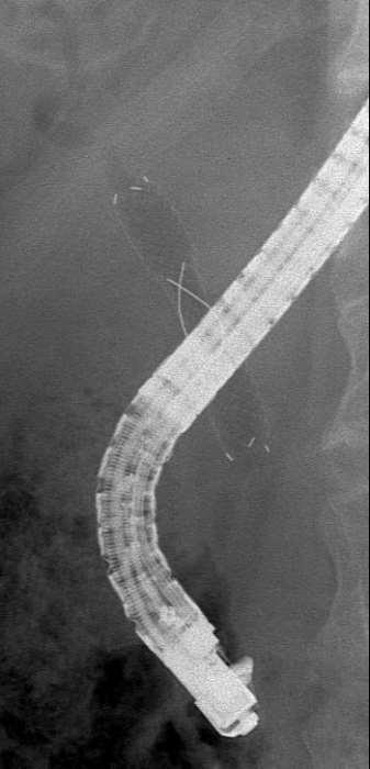 Features of BONASTENT M-Intraductal (ID) Inside placement of short length stent - Preventing duodenal reflux - Minimizing the stenting