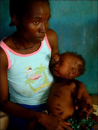Background: Perinatal and Postpartum Depression in Low Income Countries 2 Despite their increased diagnosis worldwide, these disorders receive inadequate global attention.