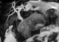 MRI Assessment Geographic areas of altered T1 signal pancreatic necrosis depicted on CECT High signal intensity on unenhanced T1 FS SGE hemorrhage and correlates with severity MRSI=CTSI using dynamic