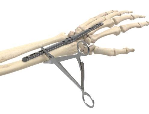 Acu-Loc Wrist Spanning Plate Surgical Technique [continued] Figure 6 5 Plate Placement and Fracture Reduction Achieve preliminary reduction by applying longitudinal traction to utilize the effect of