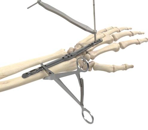 Acu-Loc Wrist Spanning Plate Surgical Technique [continued] 6 Plate Fixation Metacarpal Fixation Secure the plate first to the metacarpal to aid in the reduction of the fracture. Use a 2.