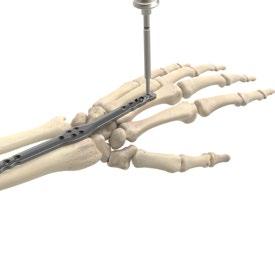 Acu-Loc Wrist Spanning Plate Surgical Technique [continued] Figure 10 Additional Screw Insertion The 2.