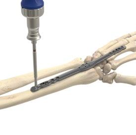 Figure 11 Note: Only unicortical screws are recommended for use in the distal radius cluster.