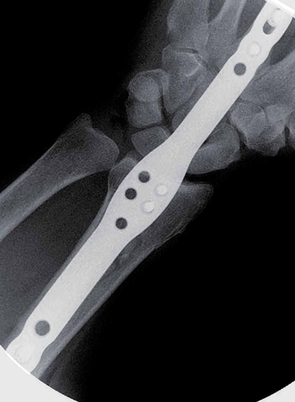 temporary basis while the distal radius heals. The Acu-Loc Wrist Spanning Plate is indicated for fixation of fractures, osteotomies, and nonunions of the radius.