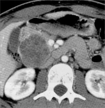 Mucinous cystic tumor 4.
