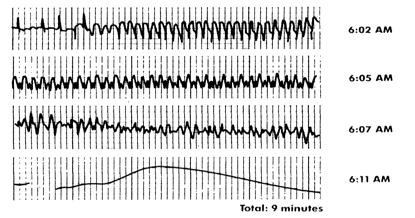 The true end point is a fully conscious, neurologically intact patient with spontaneous cardiac rhythm BRAIN INJURY is