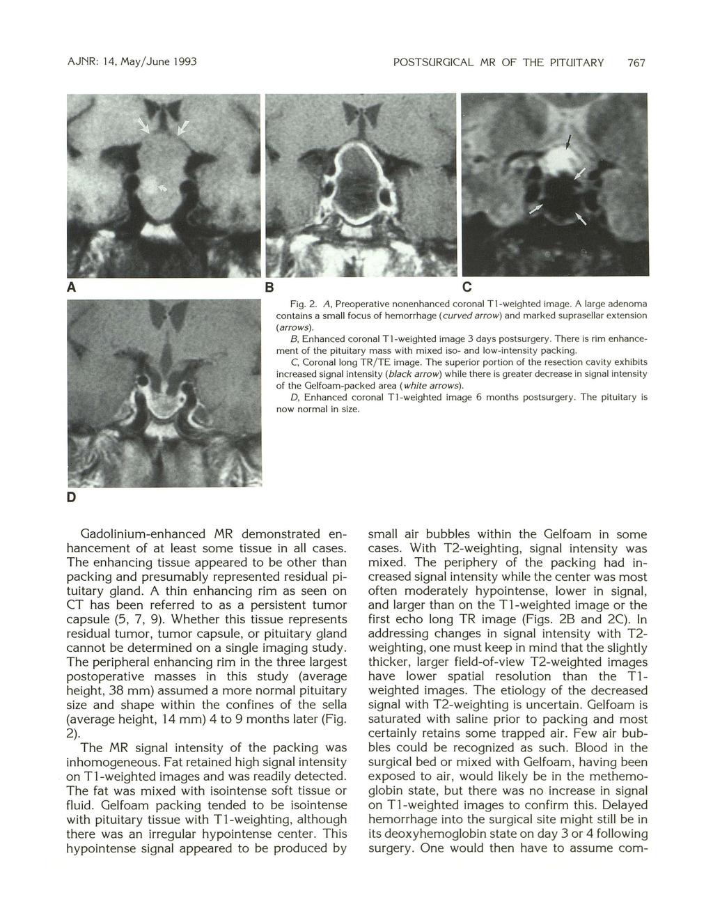 AJNR: 14, May/ June 1993 POSTSURGICAL MR OF THE PITUITARY 767 A 8 c Fig. 2. A, Preoperative nonenhanced coronal Tl-weighted image.
