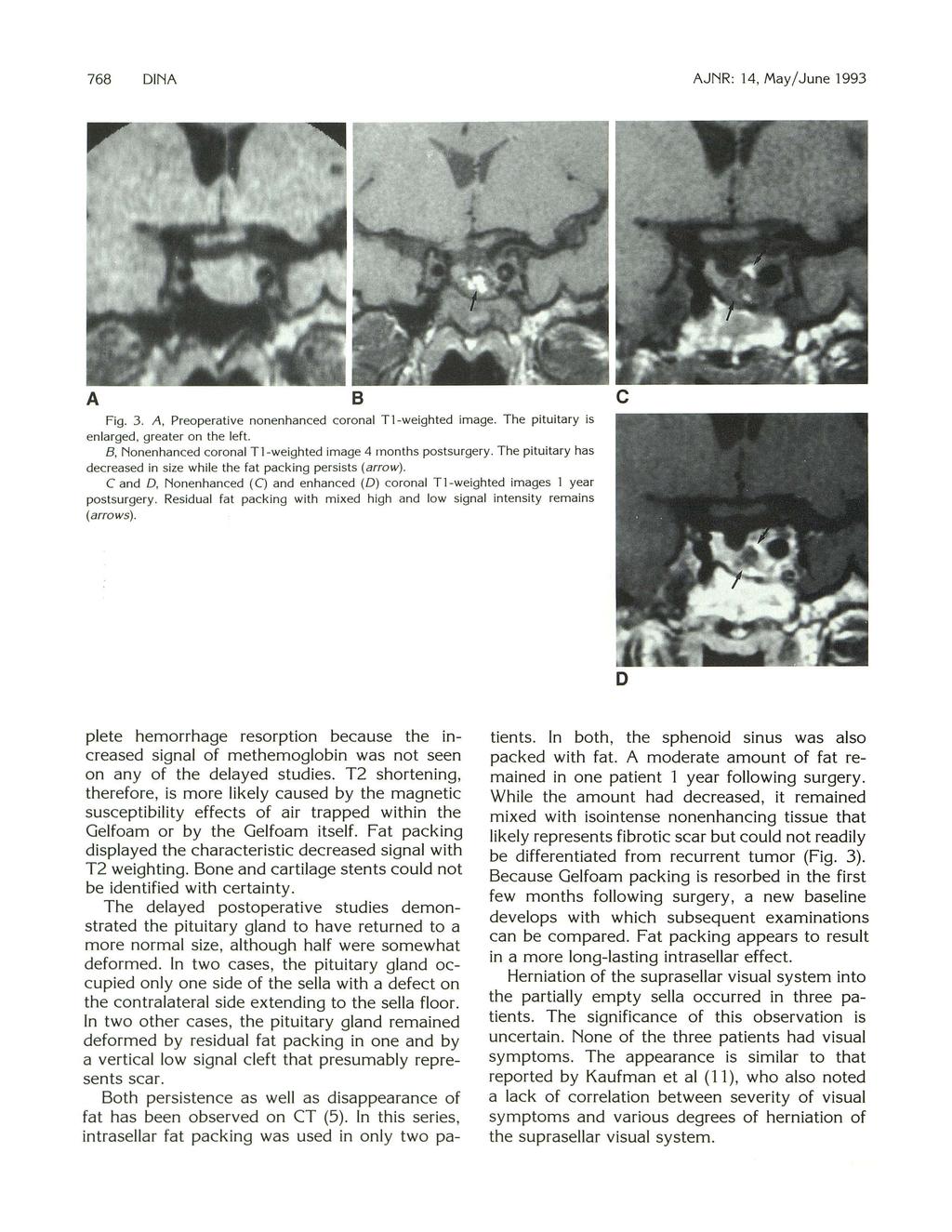 768 DINA AJNR: 14, May/ June 1993 A 8 Fig. 3. A, Preoperative nonenhanced coronal Tl-weighted image. The pituitary is enlarged, greater on the left.