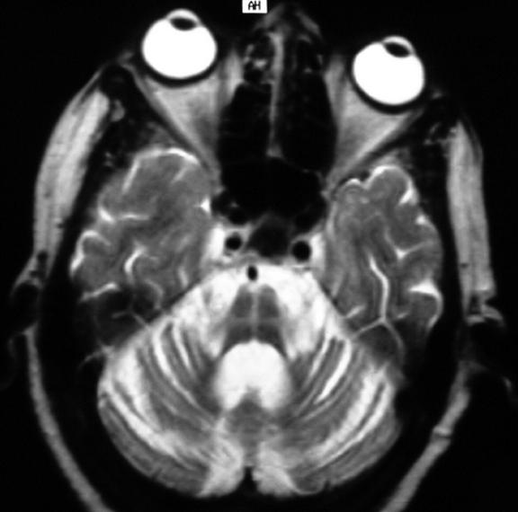 MRI in atypical parkinsonism MSA PSP Functional imaging SPECT Tracers